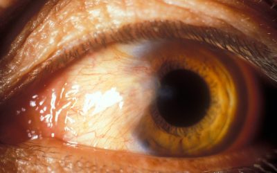 What Should You Avoid After Pterygium Surgery?