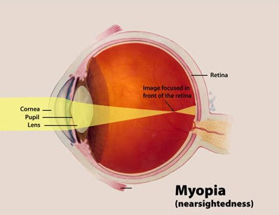 Can LASIK Correct Nearsightedness and Astigmatism?