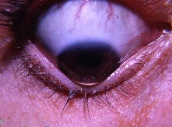 How Rare is Keratoconus?