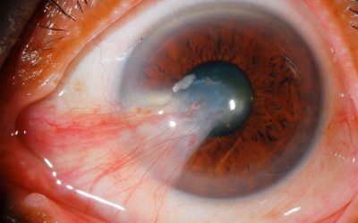 How Can You Stop a Pterygium from Growing?