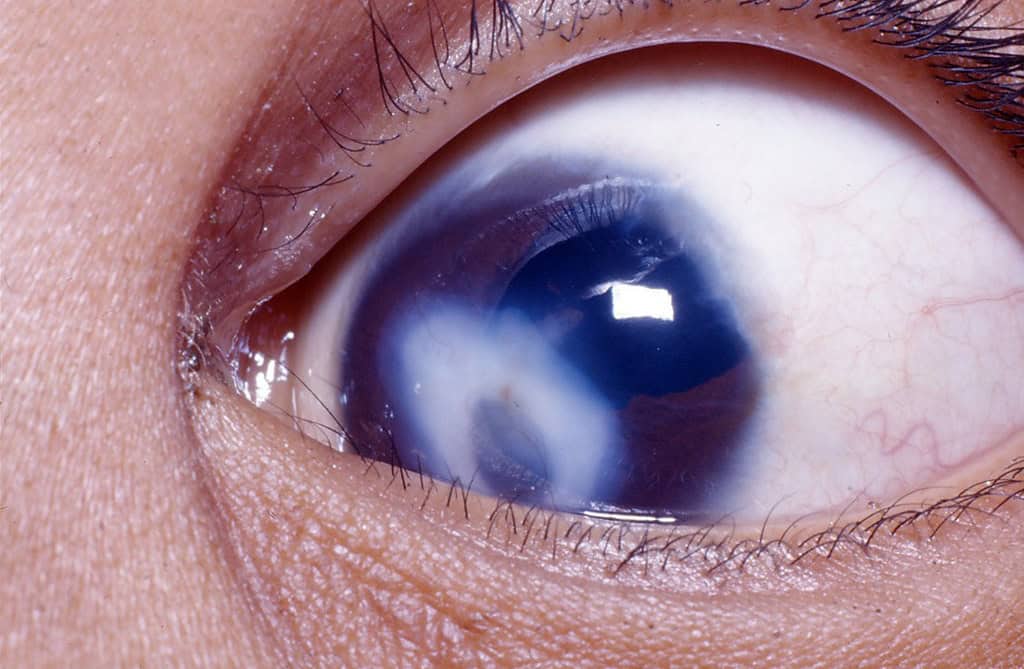 Can Corneal Scars Heal Over Time?