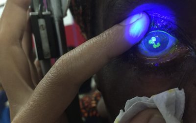 How Common is Neurotrophic Keratitis