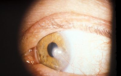 How Do Corneal Scars Heal Over Time?