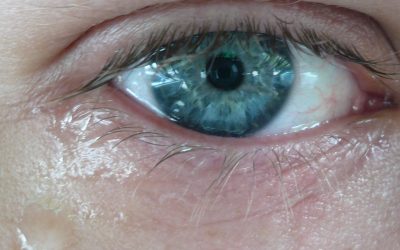 Can Watery Eyes Cause Eyelid Twitching?