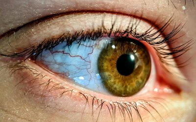 Can Trauma Cause a Hyphema (Broken Blood Vessel) in the Eyes?