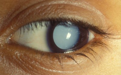 What Are Causes of Early Cataracts?