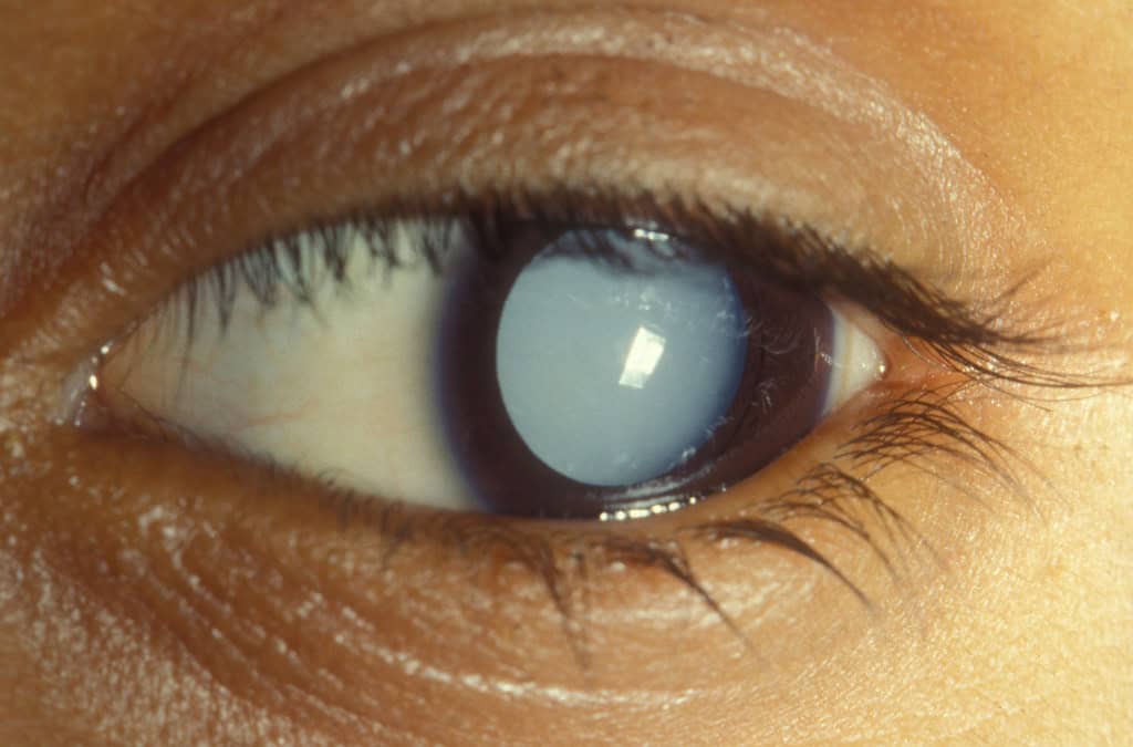What Are Causes of Early Cataracts?