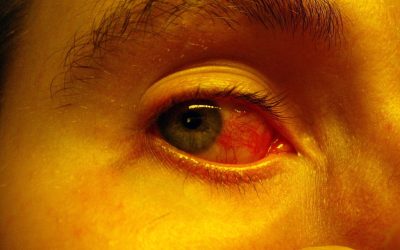 What Are Symptoms That A Corneal Abrasion Is Infected?